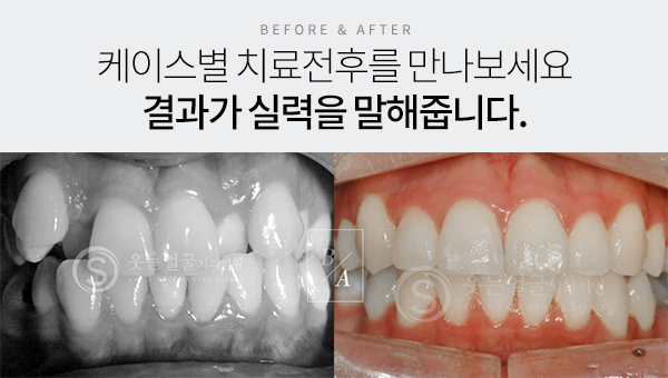 치아교정 전후사진 더 많은 사진보러가기